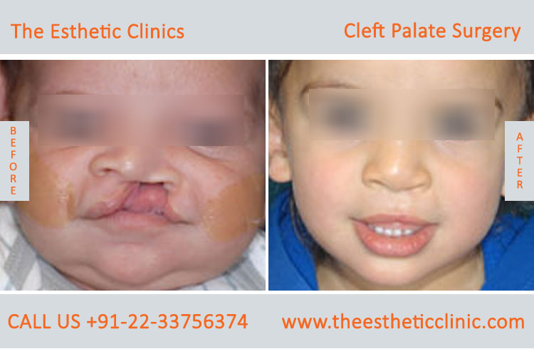cleft palate surgery, Cleft Palate Repair Treatment before after photos in mumbai india (6)